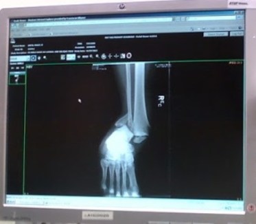 x-ray screen showing broken ankle